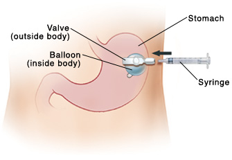 Front view of abdomen showing gastrostomy tube, balloon, and syringe..