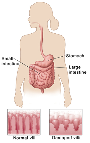 Outline of human figure showing digestive system. Insets show normal villi and short, damaged villi.