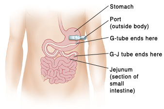 Outline of child's abdomen showing stomach and small intestine. Port is outside body over stomach. Tube is connected to port and goes through skin. G-tube ends in stomach. G-J tube ends in jejunum (section of small intestine).