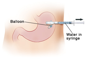 Closeup of abdomen with stomach visible inside. G-tube goes through skin with valve on outside of body and balloon inside stomach. Arrow shows plunger on syringe being pulled away from body to draw water from balloon into syringe.