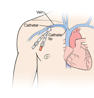 Outline of human figure with catheter inserted into vein under collarbone. Two ports are at end of catheter. Catheter can be seen in vein into heart.