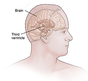 Side view of man's head showing normal ventricles in brain.