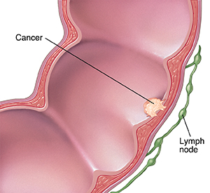 Cross section of colon and lymph nodes, showing cancer inside colon.