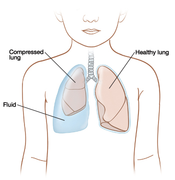 Front view of child showing fluid trapped between compressed lung and body wall on right side. Healthy lung on left.