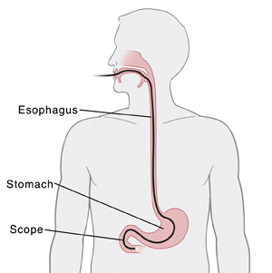 Outline of upper body showing endoscope inserted through mouth to stomach.
