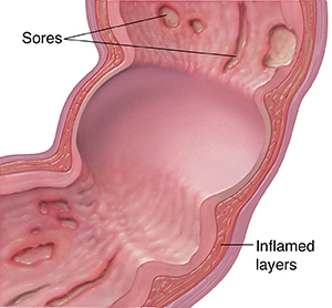 Cross section of colon showing Crohn's disease.