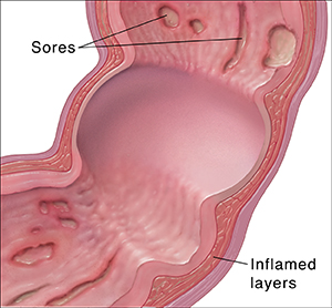 Cross section of colon showing sores and inflamed layers of intestine wall.