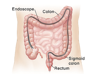 Outline of abdomen showing scope inserted through anus into entire colon.