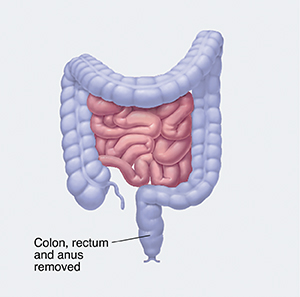 Front view of intestines with the colon, rectum, and anus highlighted showing section to be removed. 