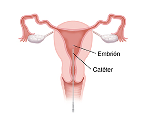 Vista frontal de un corte transversal de un aparato reproductor femenino con un catéter depositando un embrión en el útero para la fertilización in vitro.