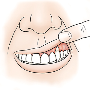 Primer plano de una boca con un dedo que levanta el labio superior para mostrar que el borde de las encías está desparejo.