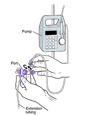 Closeup of hands disconnecting feeding bag tubing from port on extension tubing. Feeding bag tubing is connected to pump.