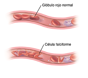 Corte transversal de un vaso sanguíneo en donde se ven células sanguíneas normales. Corte transversal de un vaso sanguíneo con anemia drepanocítica.